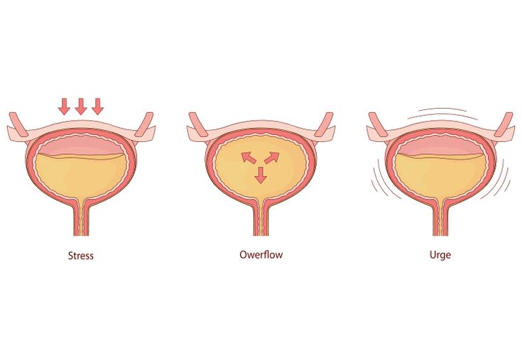 Urinary Incontinence Products: Comfort, Confidence, and Everyday Protection